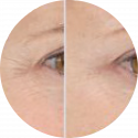before and after comparison of eyes using lightstim propanel