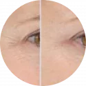 before and after comparison of eyes using lightstim propanel