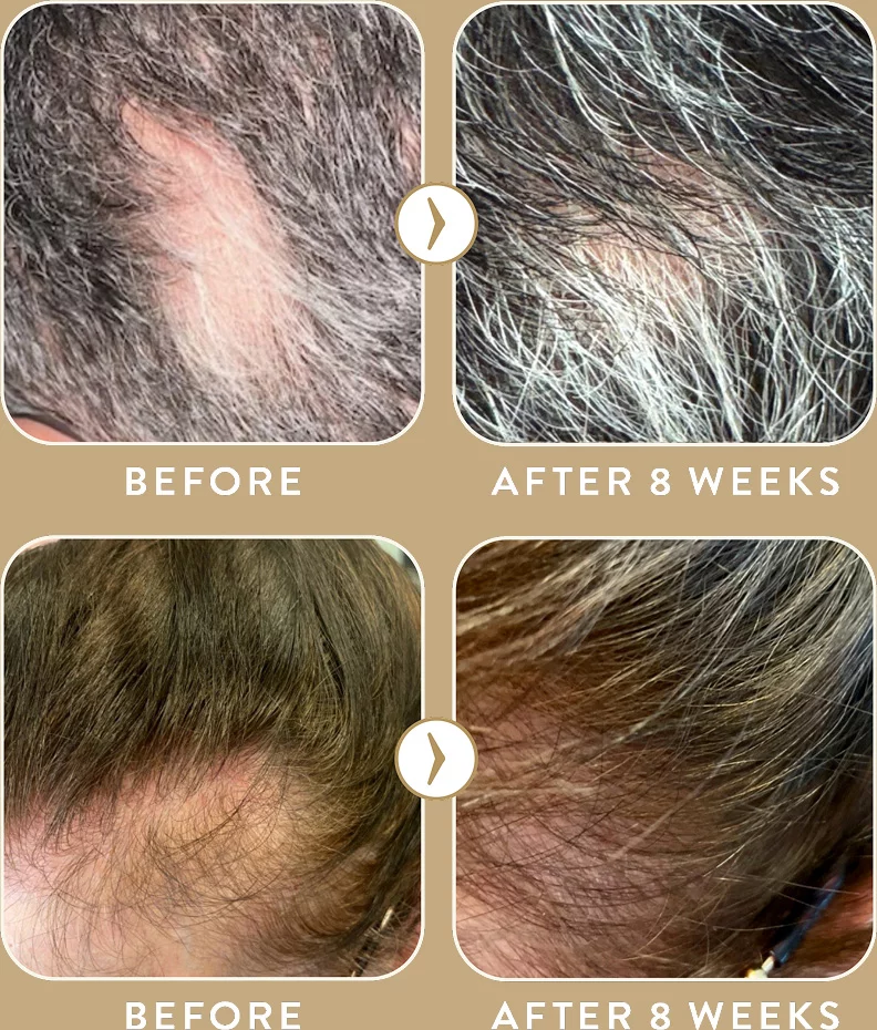 Exosomes for hair before and after 8 weeks