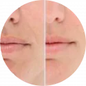 before and after comparison of lips using lightstim propanel
